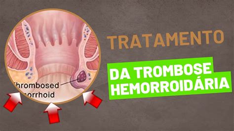 Fotos de hemorroidas (externas, internas e trombose)